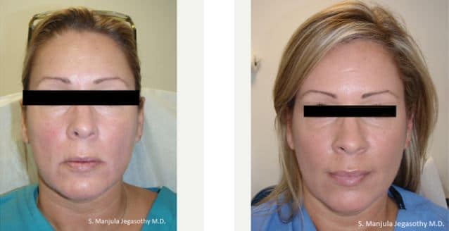 Dysport® and Sculptra® for sagging cheeks and jawline