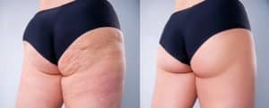 After QWO Cellulite Treatments butts look better than before.