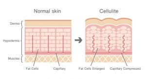 Cross section of Normal Skin versus Cellulite