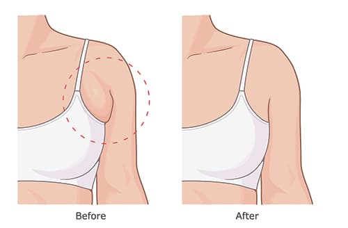 bra line fat reduction