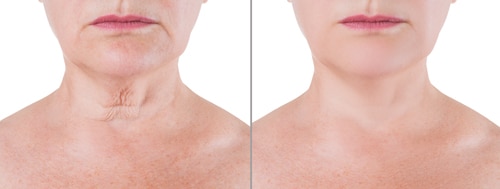 Before and after nonsurgical necklift
